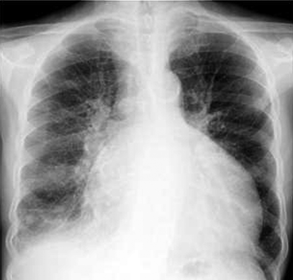 Röntgen bei Herzmuskelmüdigkeit