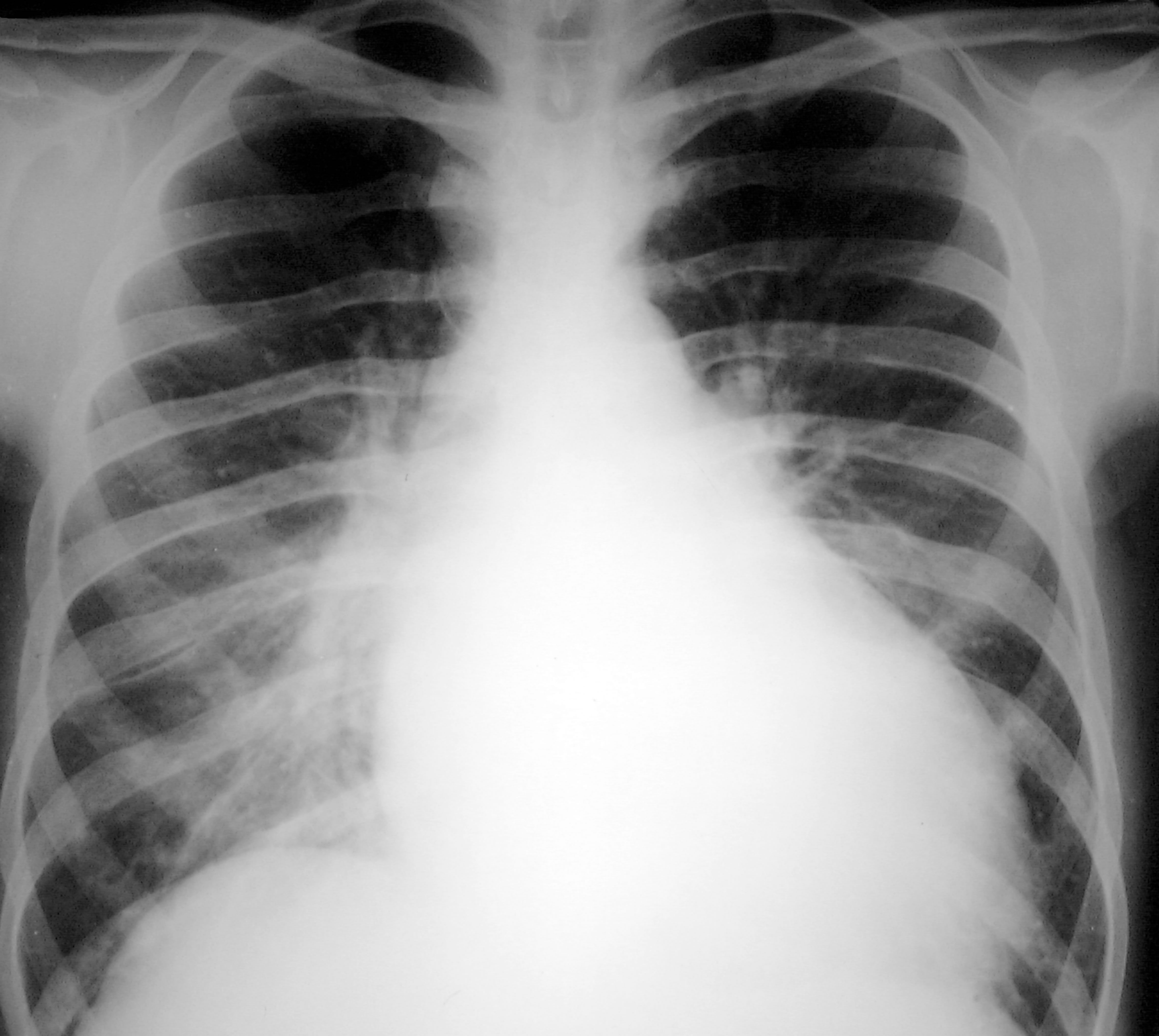 Erguss im Röntgen