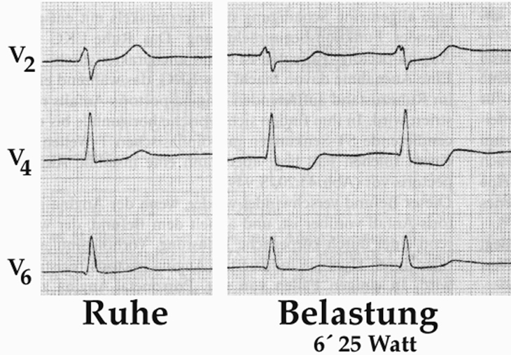 Belastungs-EKG